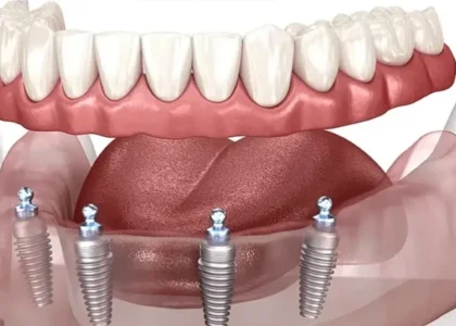 All on Four Implant