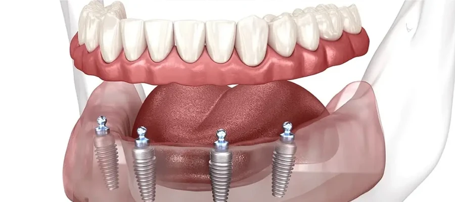 All on Four Implant