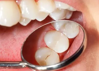 Dental Filling