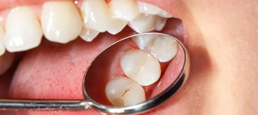 Dental Filling