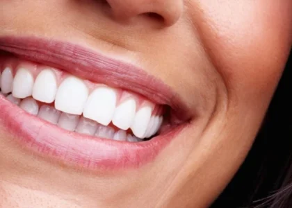 Dental Veneers