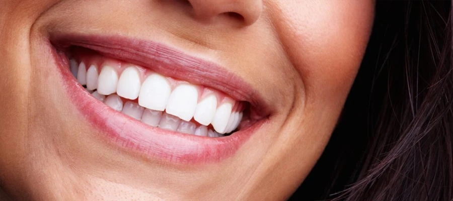 dental veneers