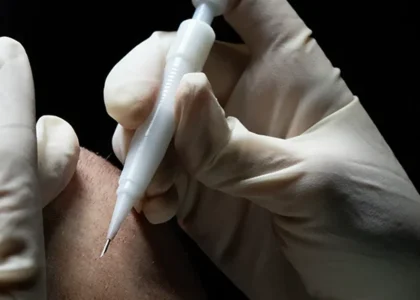 DHI Hair Transplantation