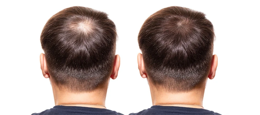 fue hair transplant