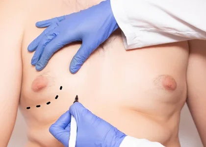 Gynecomastia