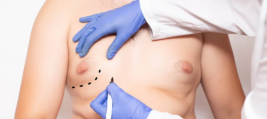 Gynecomastia