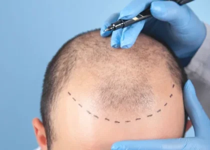 Hair Transplant