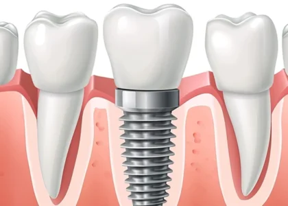 Implant Treatment
