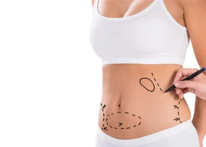 Liposuction
