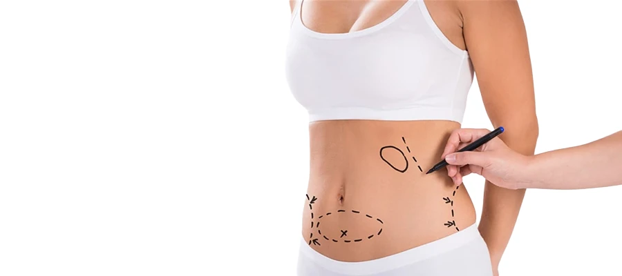 liposuction