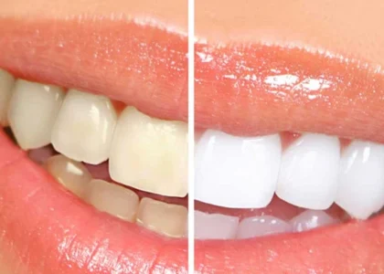 Teeth Whitening