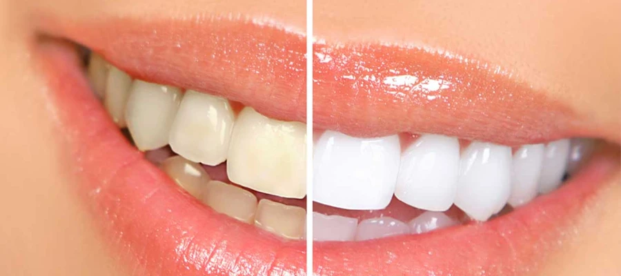 teeth whitening