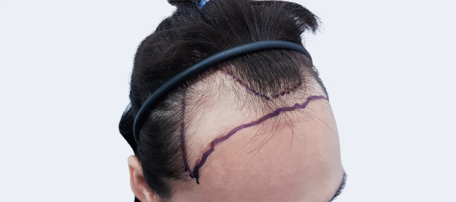Unshaven Hair Transplantation